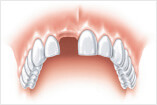 Behandlung Einzelzahnlücke verlorener Zahn Zasel
