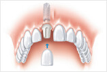 Behandlung Einzelzahnlücke Zahnkrohne Basel