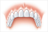 Behandlung Einzelzahnlücke Zahnreihe Basel
