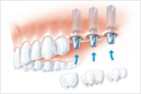 Behandlung große Zahnlücke Einzelzähne Basel