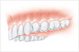 Behandlung große Zahnlücke Natürliche Funktion Basel