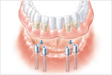 Behandlung Zahnloser Kiefer Unterkiefer Prothese Basel